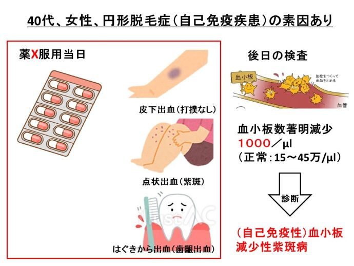 円形脱毛症　病院